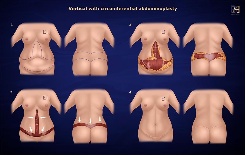 Circumferential Hybrid abdominoplasty