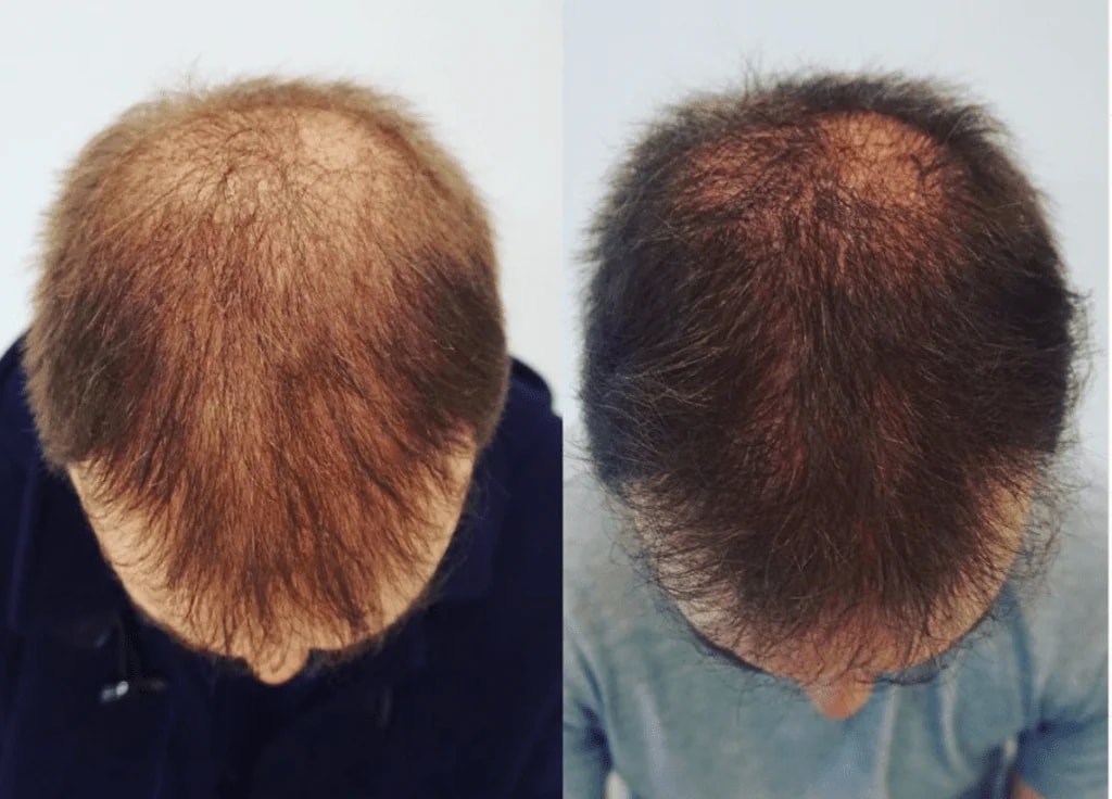 alopecia-androgenica-tratamiento-madrid