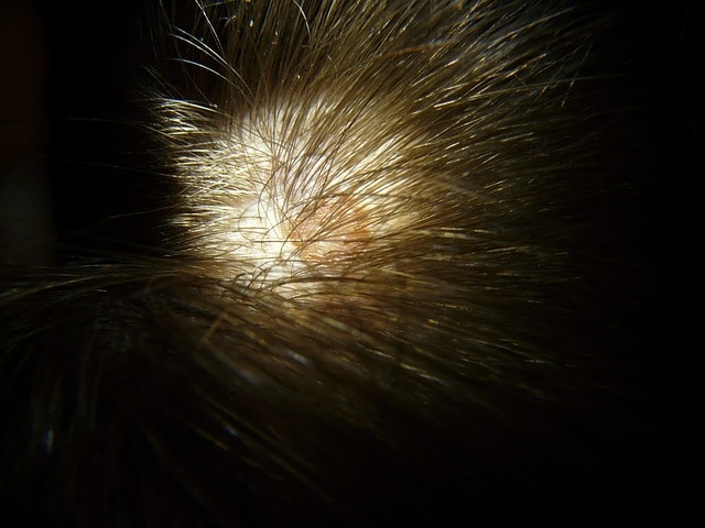 Close-up of a person’s scalp with a liver spot. 