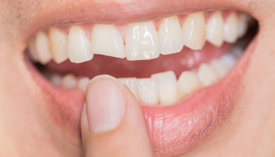 broken teeth