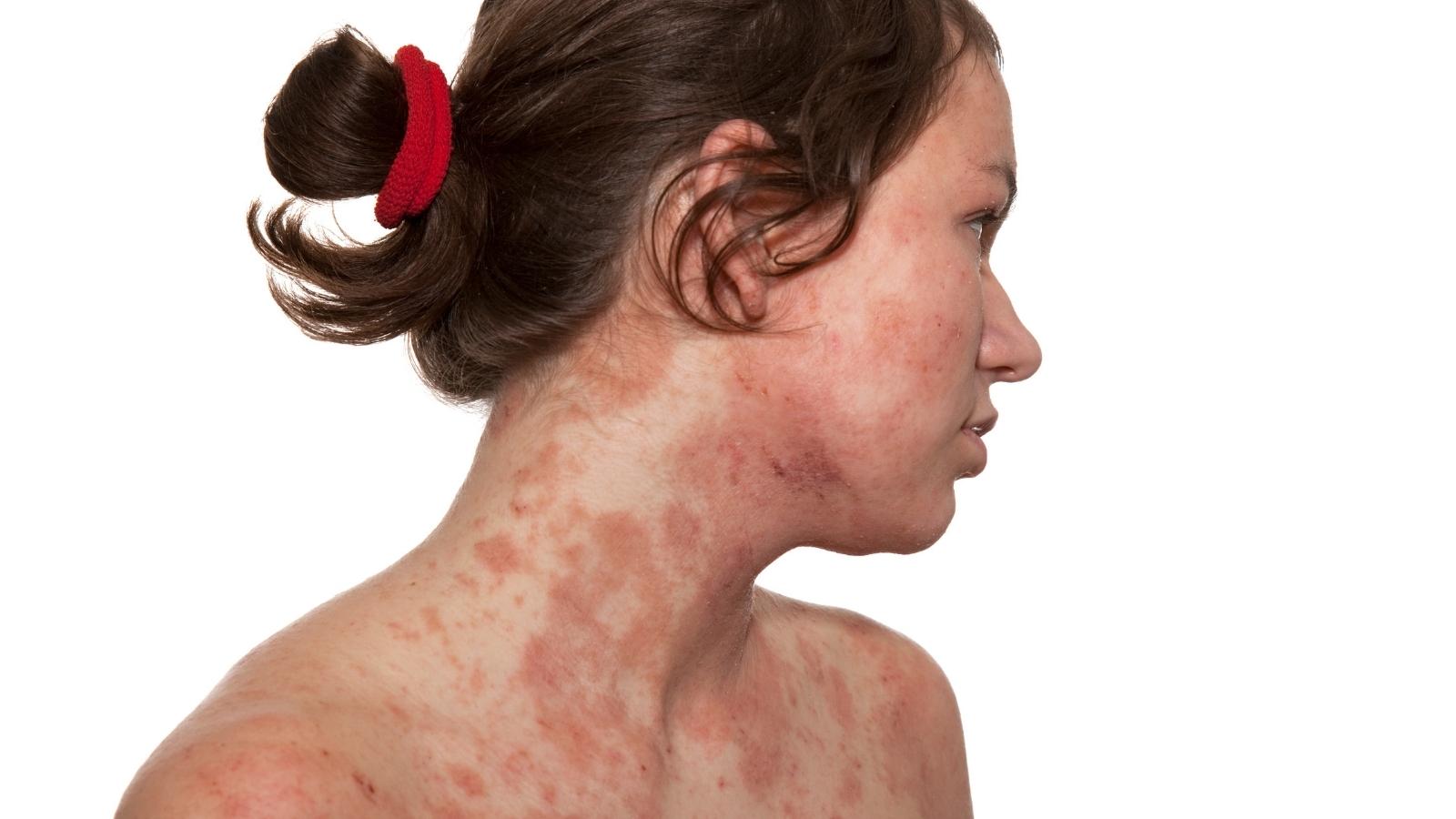 atopic dermatitis
