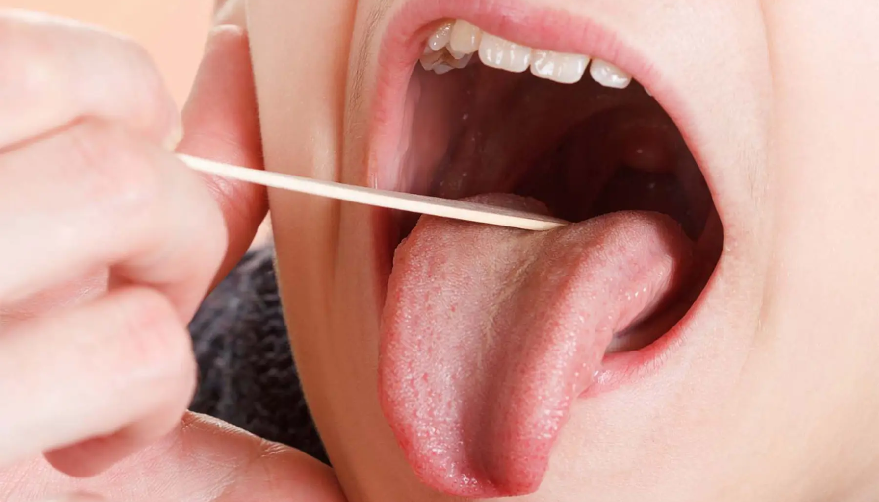 Hoven Tunge: Når Hevelse Gjør Det Ubehagelig å Snakke og Spise 15 Nærbilde av åpen munn der tunge undersøkes med pinne, viser overflate, farge og mulig munnhelsetilstand hos pasient