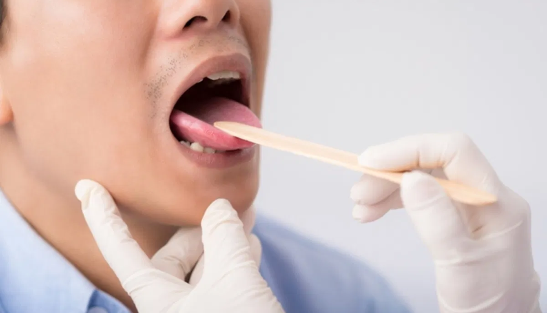 Lege undersøker halsen på en pasient med trepinne og hansker, mens pasienten har munnen åpen.