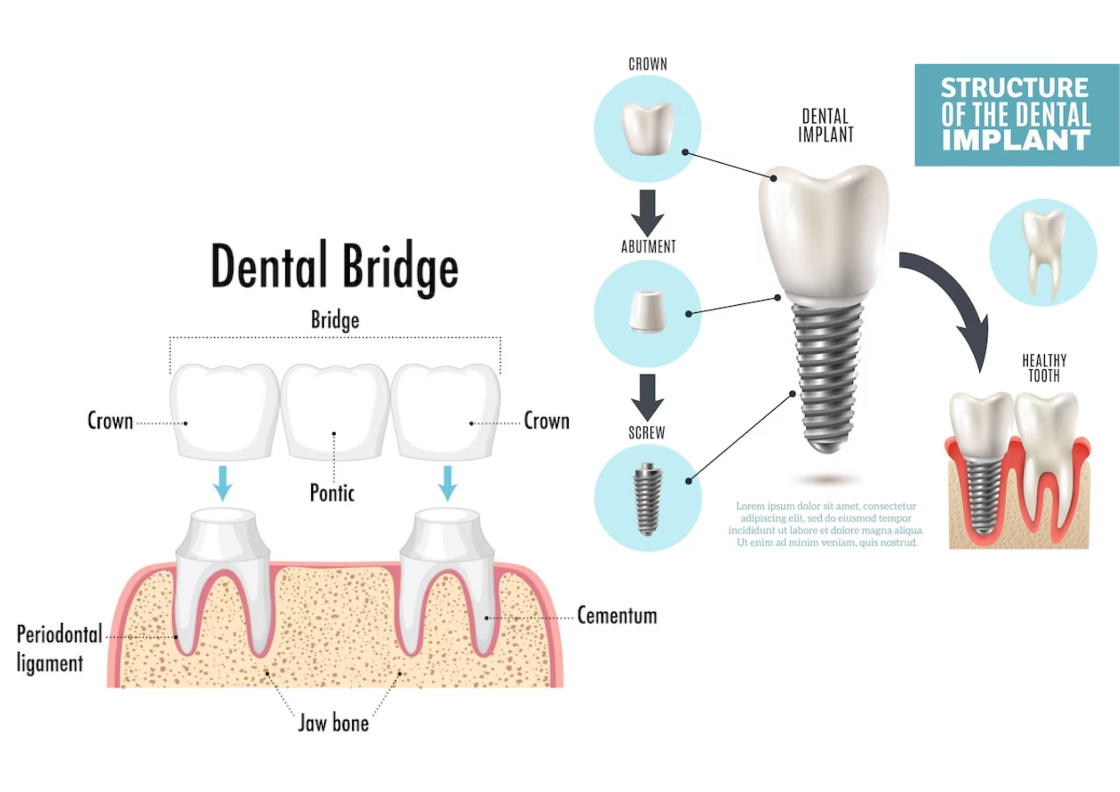 A comparison of dental implants and bridges