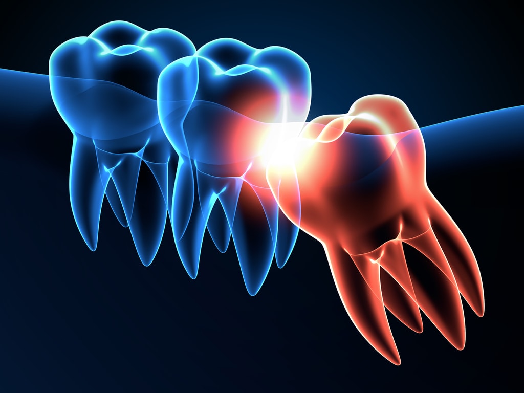Impacted wisdom teeth can cause damage to neighboring teeth such as crowding, infection, decay and gum disease