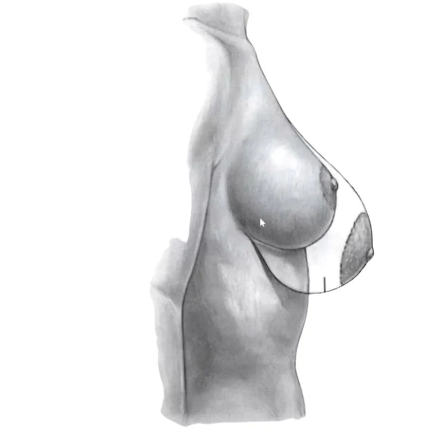 Una imagen que muestra los cuidados posoperatorios de la cirugía de reducción de senos, incluido el vendaje adecuado para heridas y las técnicas de manejo del dolor.