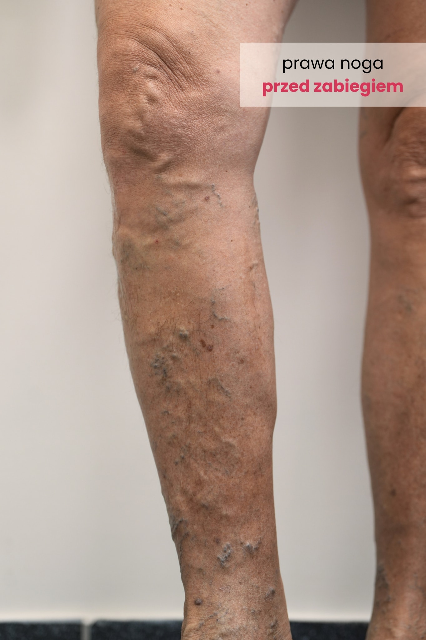 Zdjęcie prawej nogi Pacjenta przed zabiegiem skleroterapii