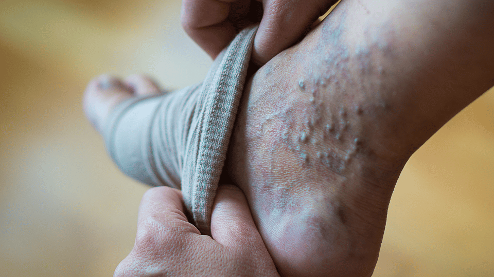 Varicose Veins Stockings
