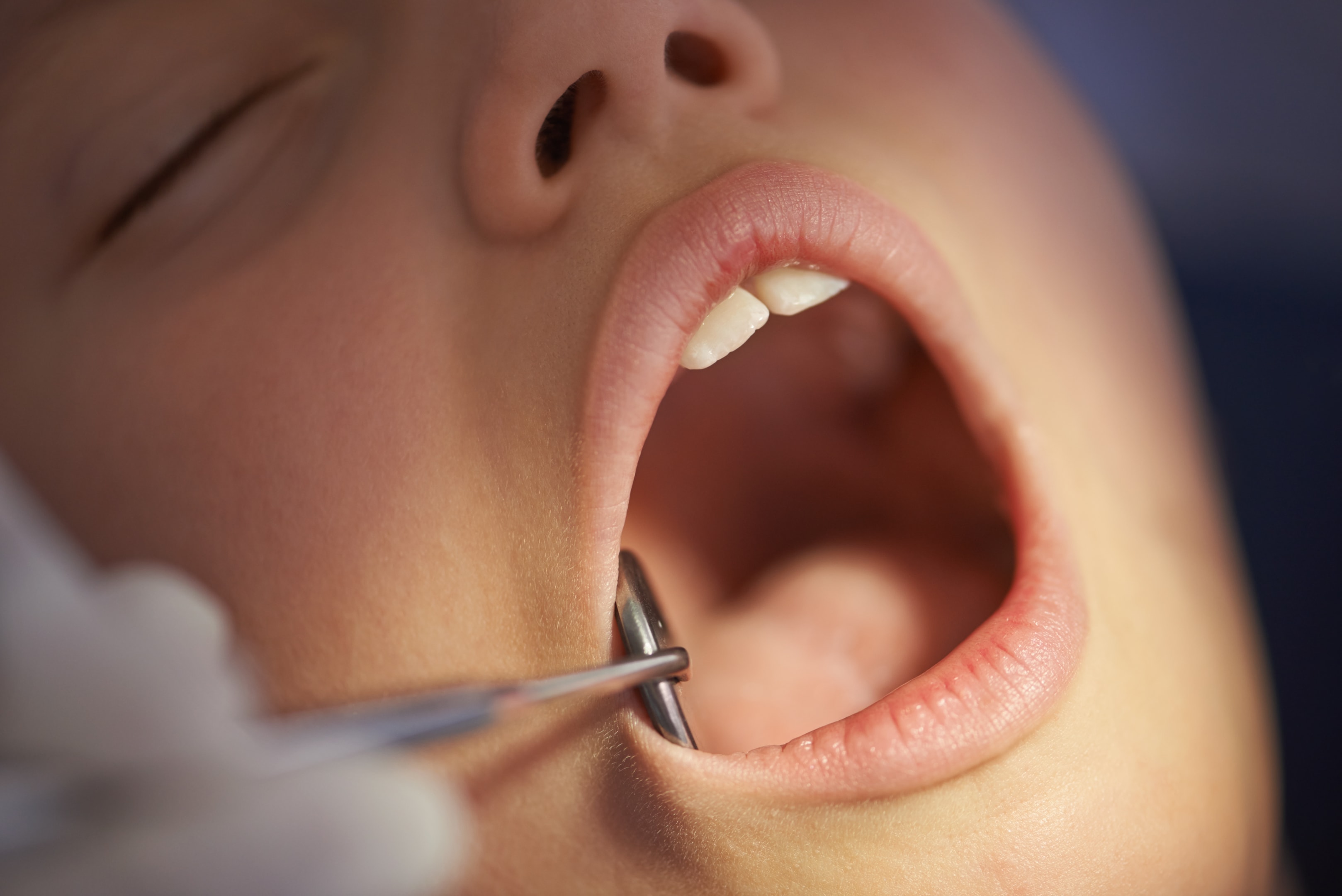 Person getting checked to see if wisdom teeth need to be removed