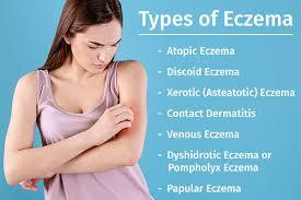 Remedies for Eczema Allergies That You Can Try