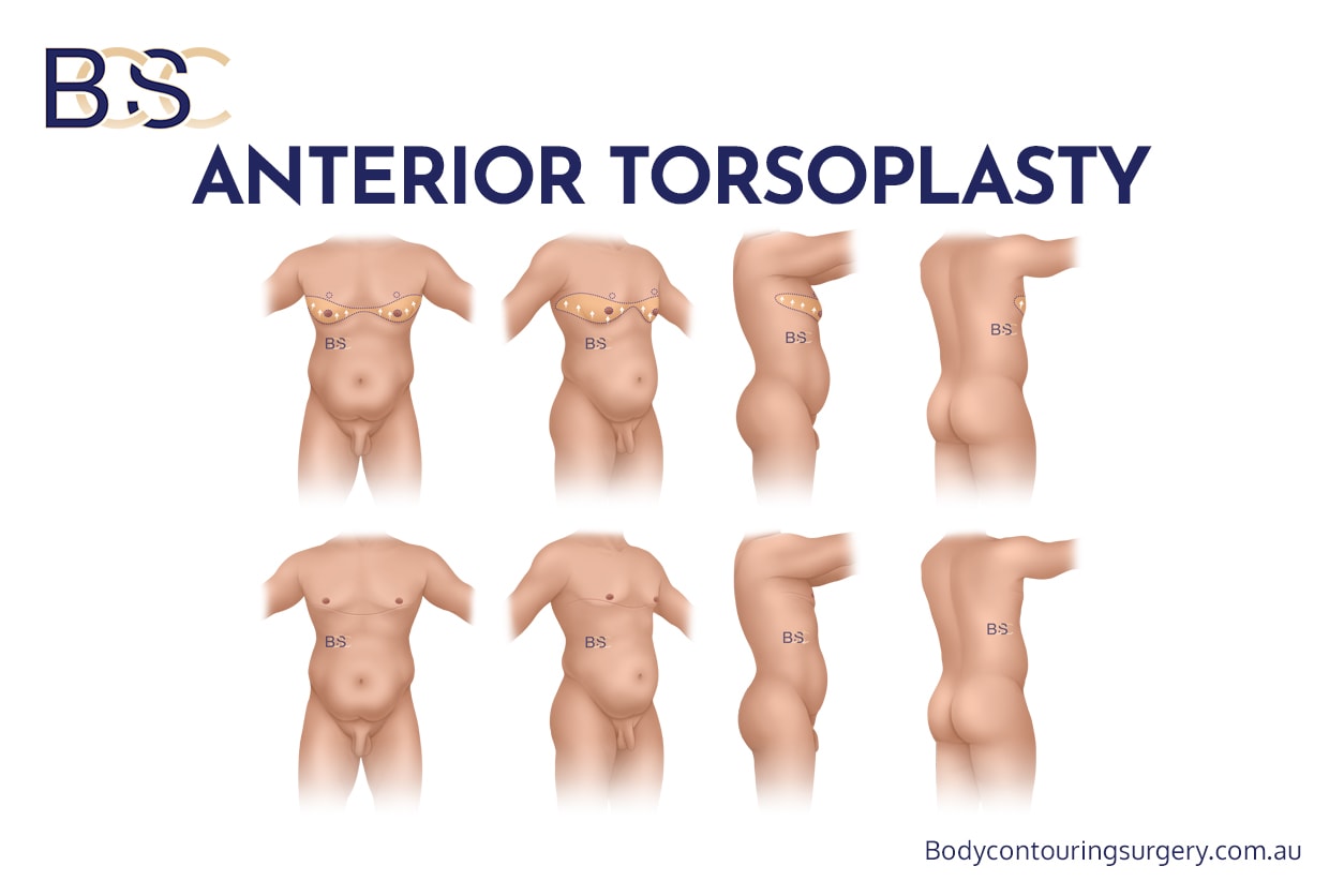 Anterior torsoplasty (Mastectomy for gynaecomastia)
