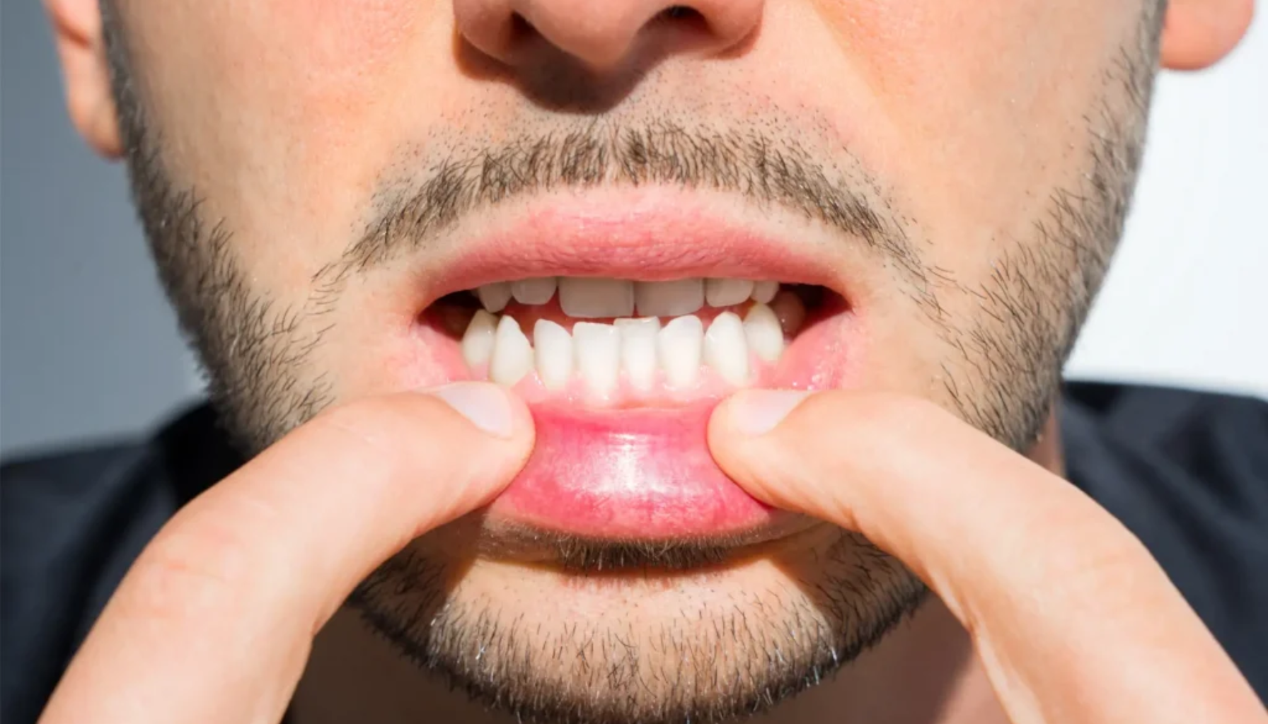 Gom Tenner: Når Tennene Ikke Møtes Som De Skal 11 Mann trekker ned underleppen for å vise tannkjøtt og tenner, fokus på tannhelse og mulig irritasjon generelt
