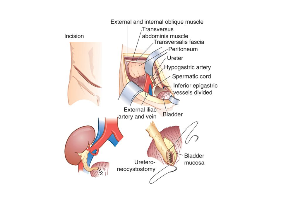 Immediate Post-Surgery Wound Care