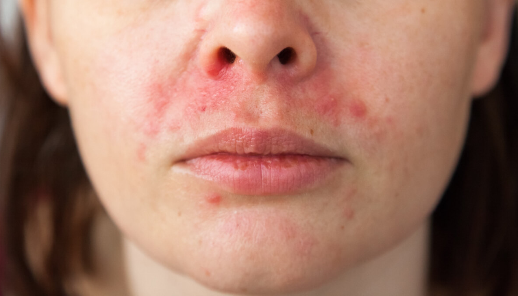 Rød irritasjon og små blemmer rundt nese og munn, typisk for hudtilstanden perioral dermatitt hos voksne.