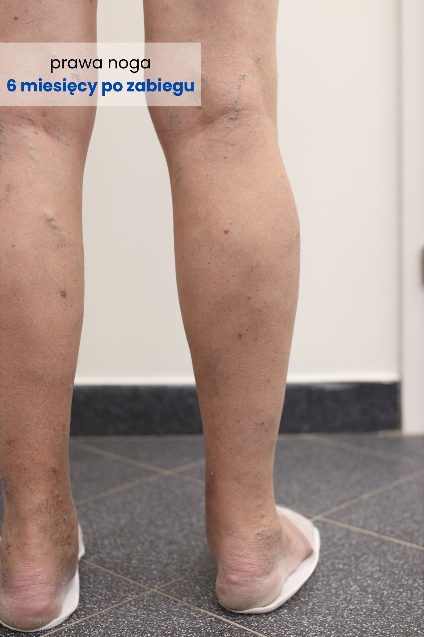 Zdjęcie prawej nogi Pacjenta 6 miesięcy po zabiegu skleroterapii - efekt