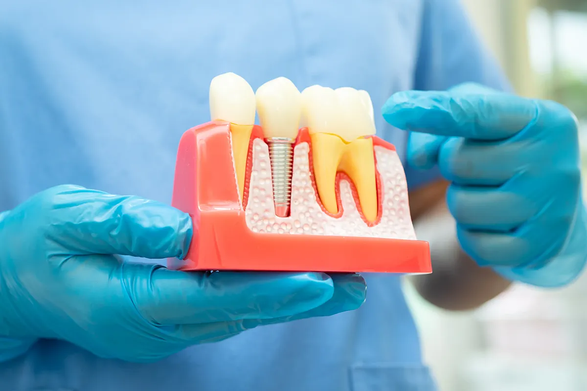 Anatomical model showing dental implant placement in jawbone cross-section