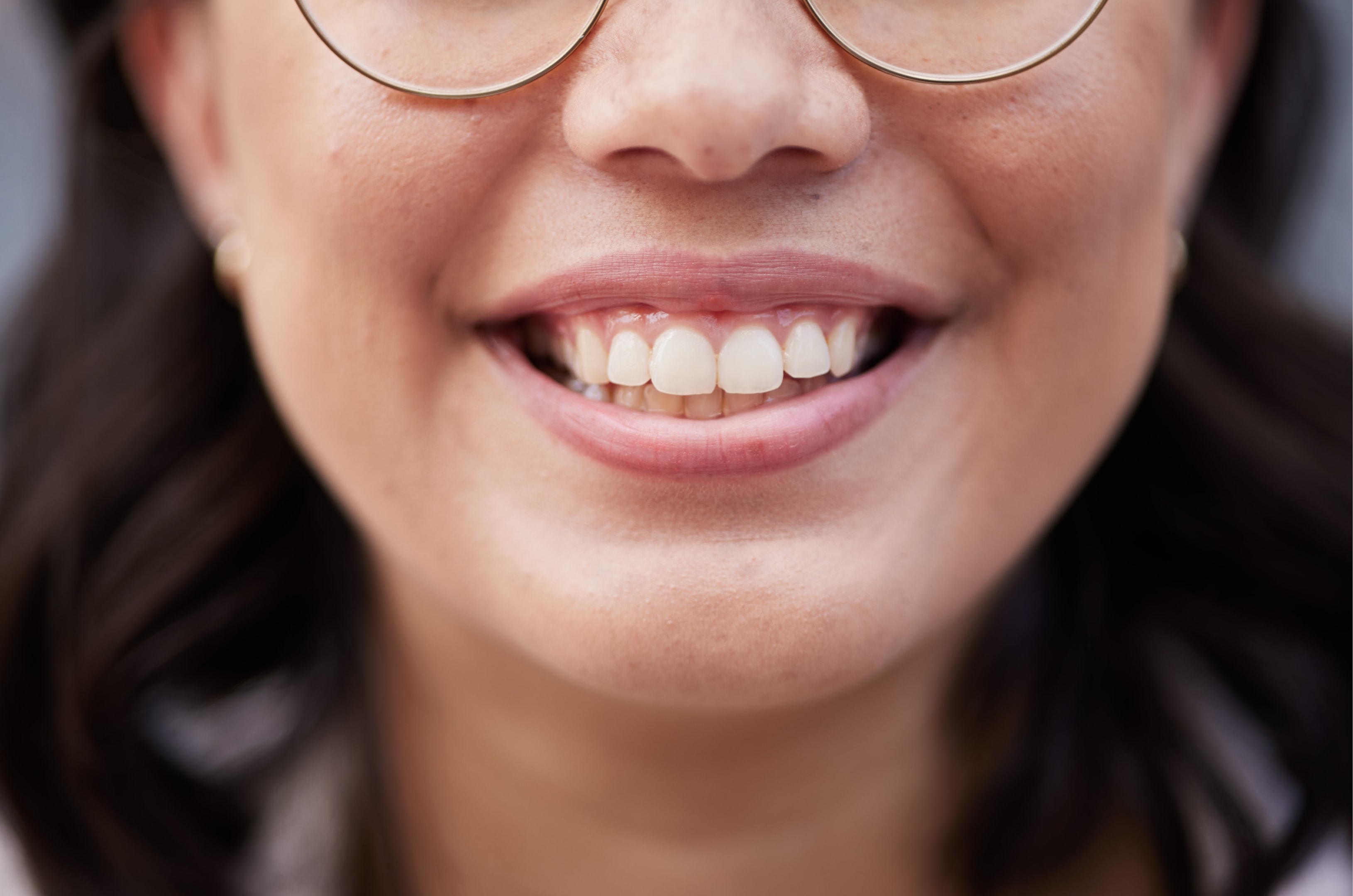 a patient who has an overbite due to upper jaw misalignment. they would benefit from jaw surgery