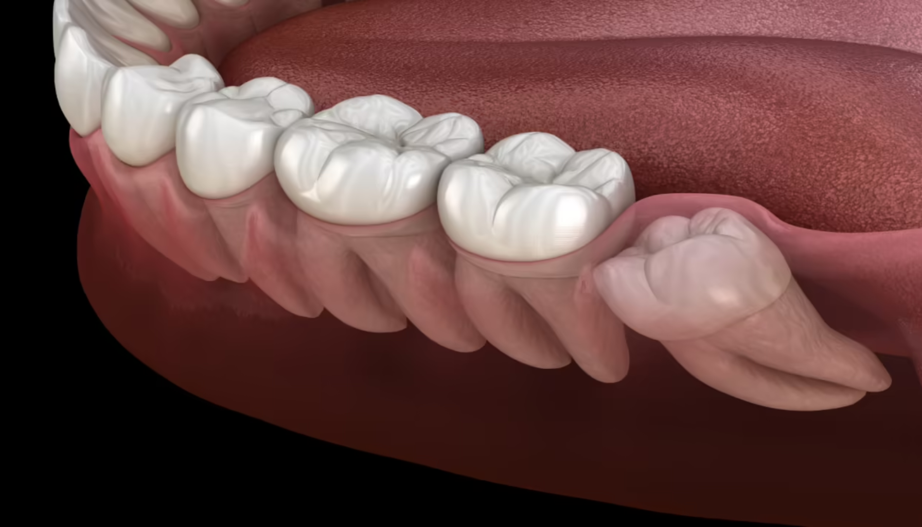 3D-illustrasjon av visdomstann som vokser sidelengs og sitter fast i kjevebenet.