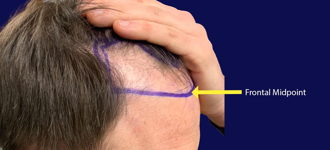Dr Kunnure Clinic - Hair transplant - Hairline design