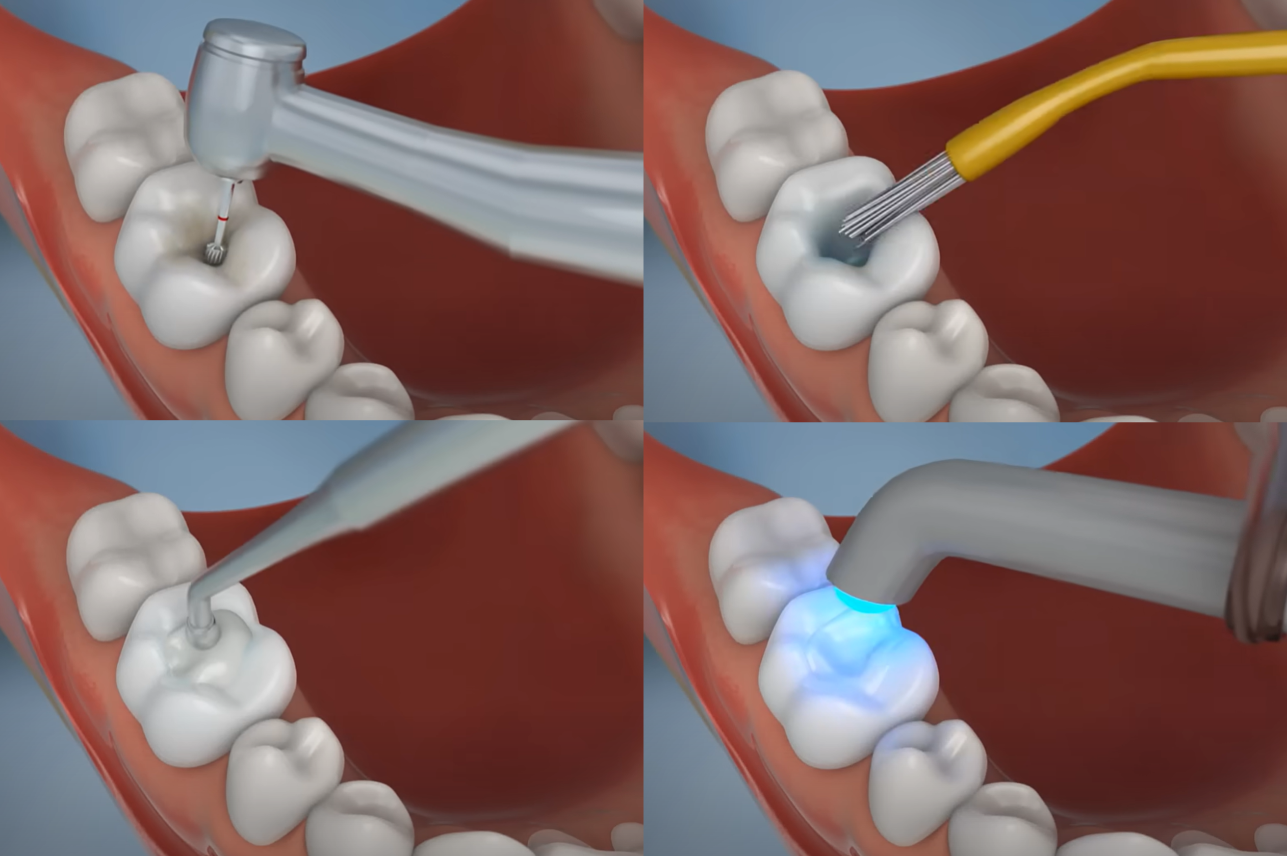 Composite Filling Procedure