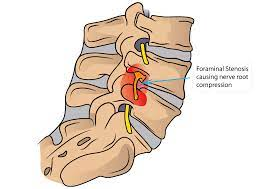 Spinal or foraminal stenosis can cause sciatica.