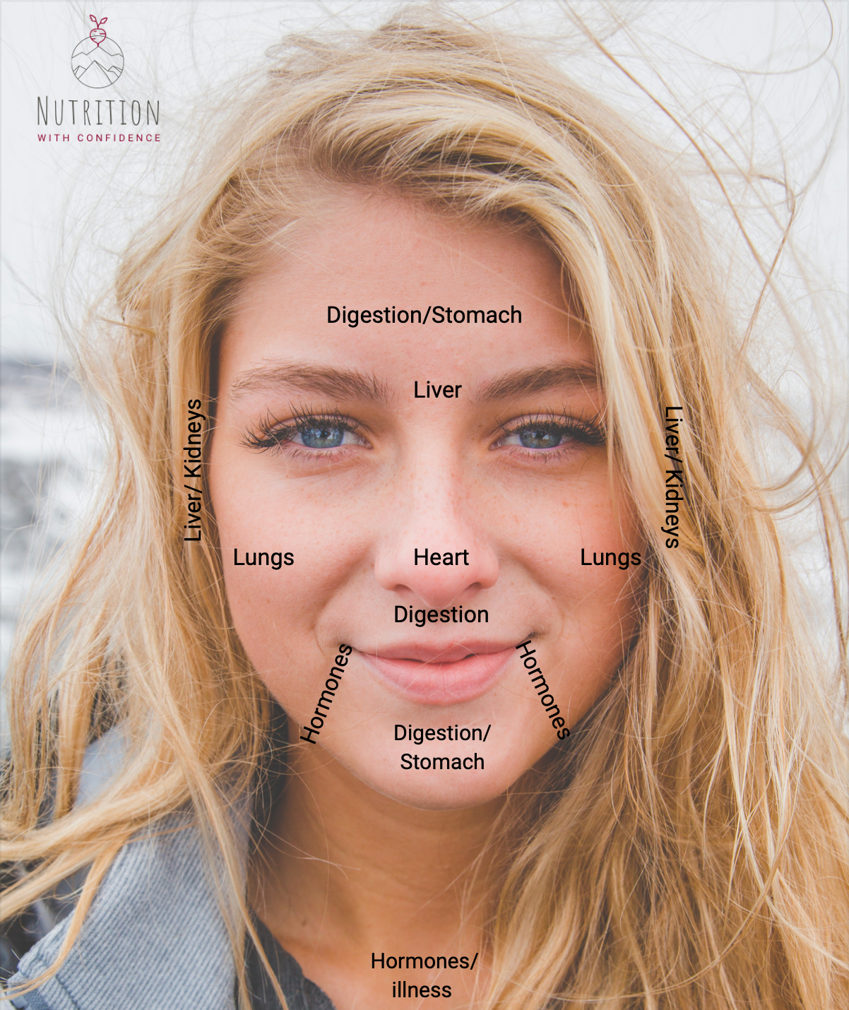 Areas that acne can appear based on hormone imbalance