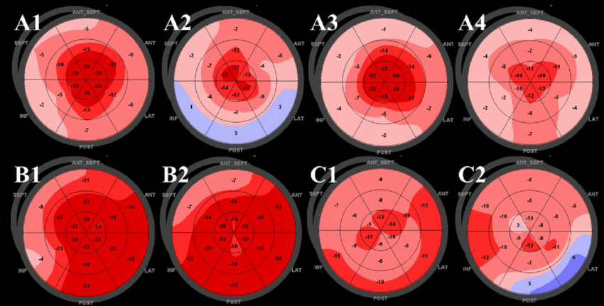 Speckle Tracking Echocardiography