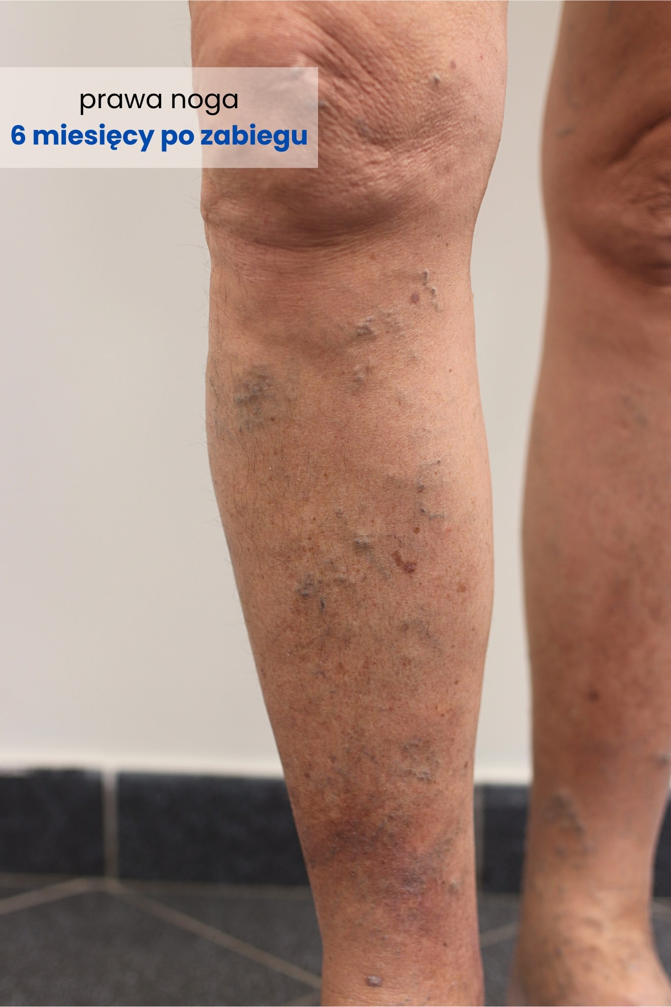 Zdjęcie prawej nogi Pacjenta 6 miesięcy po zabiegu skleroterapii - efekt