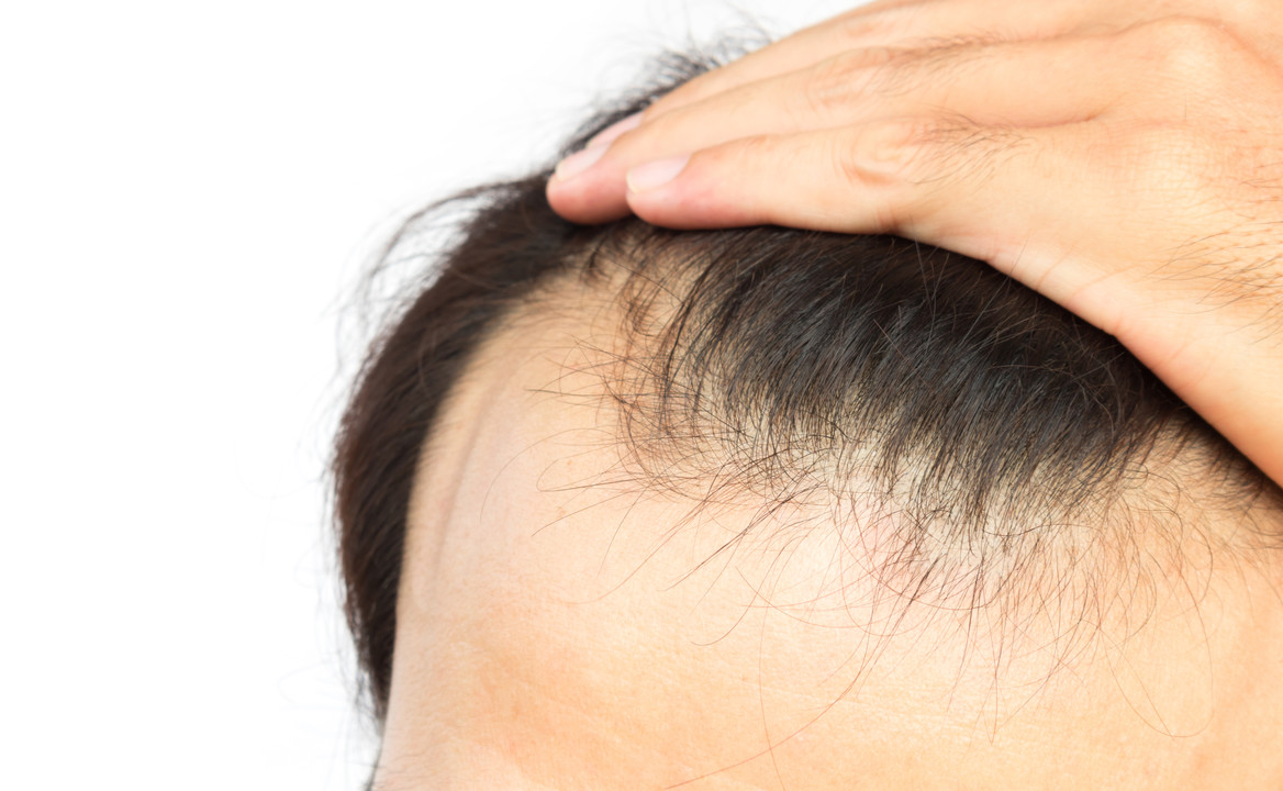 androgenic alopecia hair loss