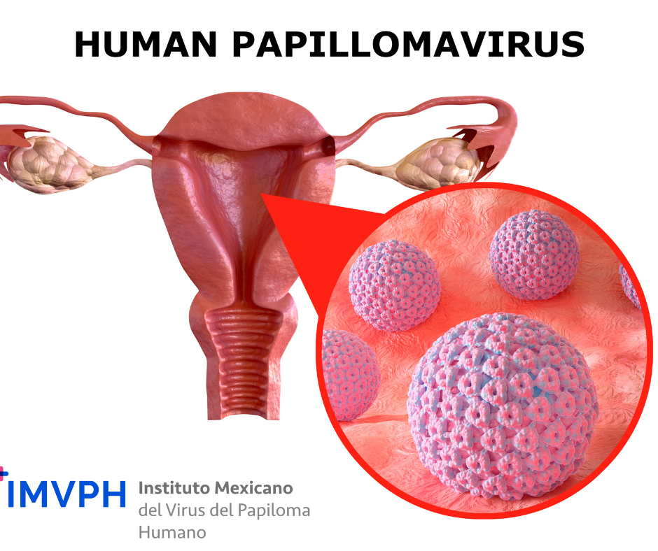 El virus del papiloma humano causa cáncer, displasia, verrugas y otras afecciones 