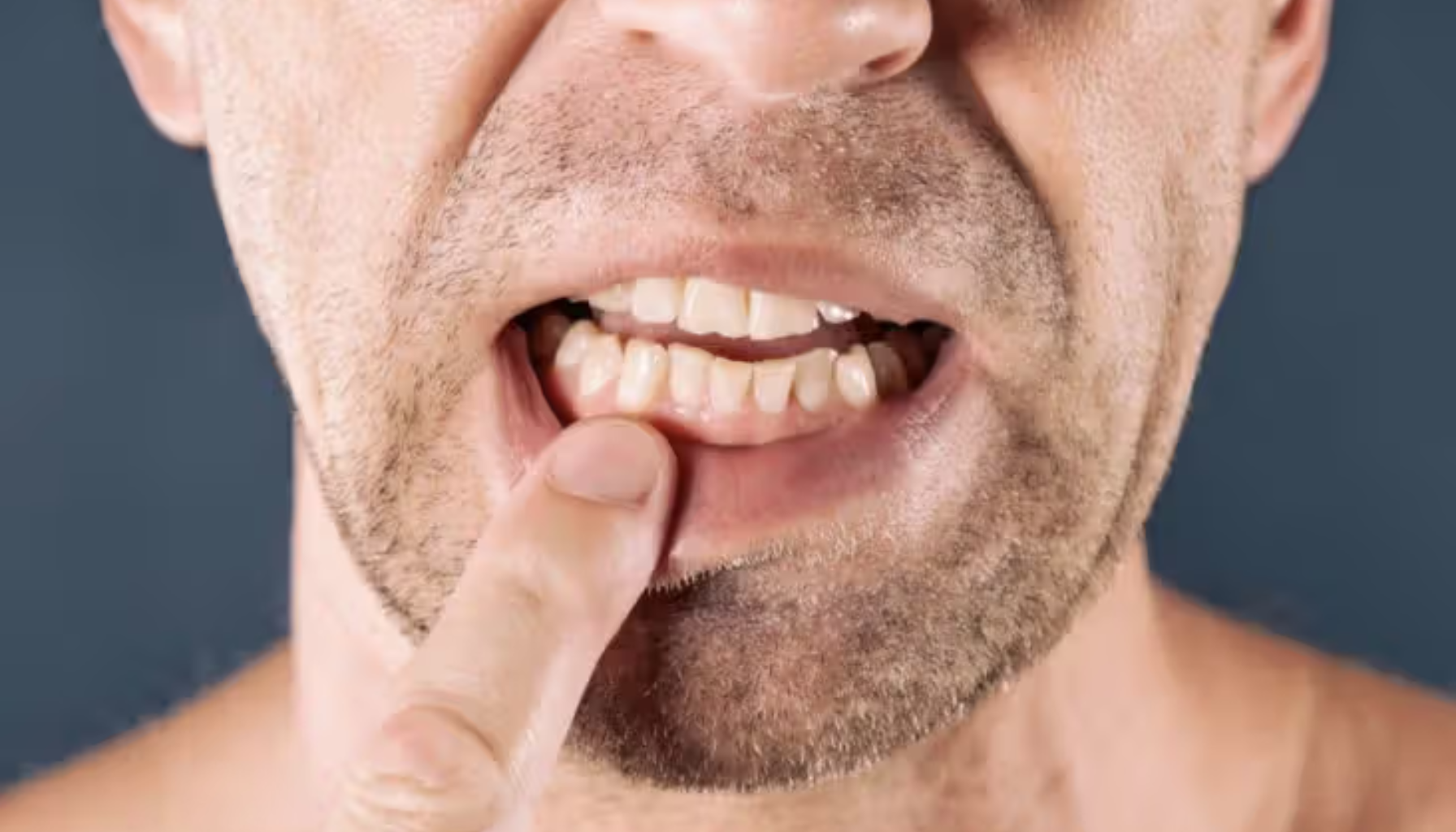 Mann trekker ned underleppen for å vise betent og irritert tannkjøtt på nedre tenner.