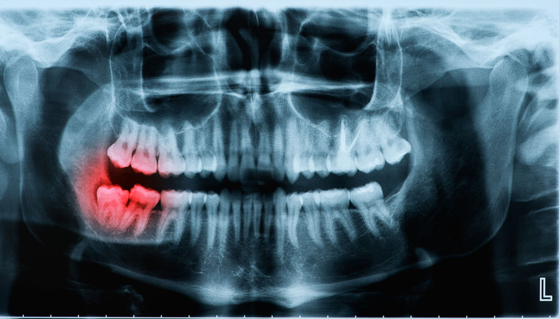 Perikoronitt: Når visdomstannen skaper betennelse 16 "Røntgenbilde av kjeve som viser retinert visdomstann markert i rødt, pressende mot nabotenner." perikoronitt odontogene infeksjoner åpne munnen dårlig ånde oppsøke tannlege betennelse i bløtvevet tannkjøttet rundt delvis frembrutte dårlig smak nok plass bløtvevet rundt rundt tannen smerte hevelse rundt delvis visdomstann perikoronitt oppstår smerter hevelse infeksjon behandling infeksjoner symptomer bør tannlege visdomstenner tannkjøttet betennelse hevelse tannen rundt bakterier ofte smerte visdomstennene munnen visdomstannen smerter tann tenner delvis komplikasjoner oppstår tannlegen tennene mer føre tilfeller tilstanden dårlig kirurgisk feber infeksjonen kommer unngå puss dersom fjerning frem gjennom viktig alvorlig kjeven under alvorlige behandlingen vondt trekke får betennelsen nødvendig symptomene grunn oftest utvikle antibiotika gir hos raskt vanligvis behandles akutt andre