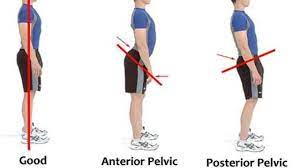 Posterior Pelvic Tilt : Cause, Symptom, Treatment, Physiotherapy Exercise