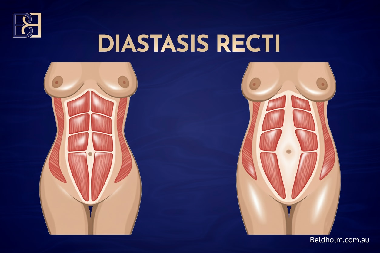 Recovering from Dual-Vector Abdominoplasty 7 Diastasis recti | Dr Bernard Beldholm
