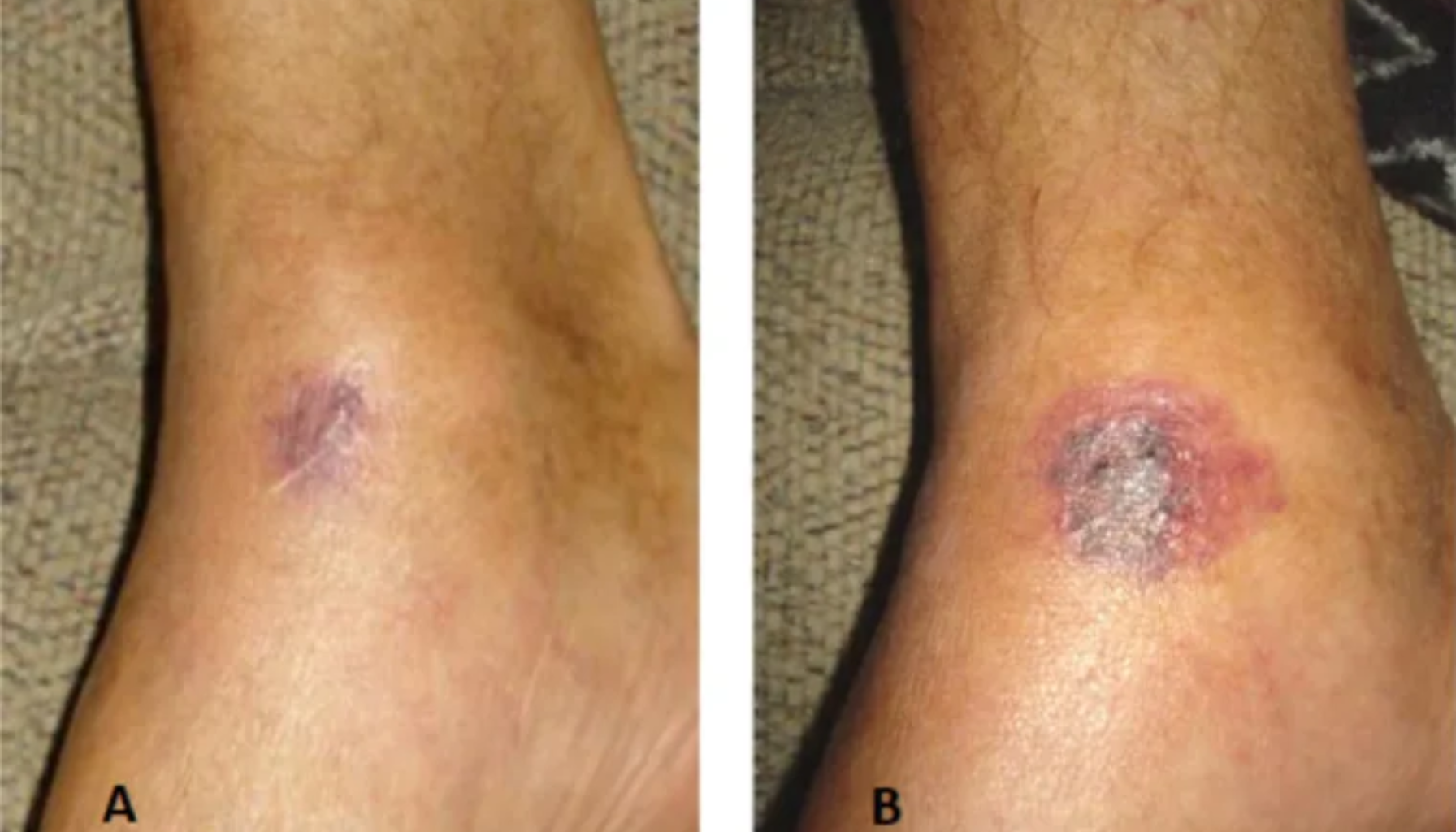 To bilder av hudlesjoner på ankel med sår og misfarging, viser infeksjon eller betennelse i huden.