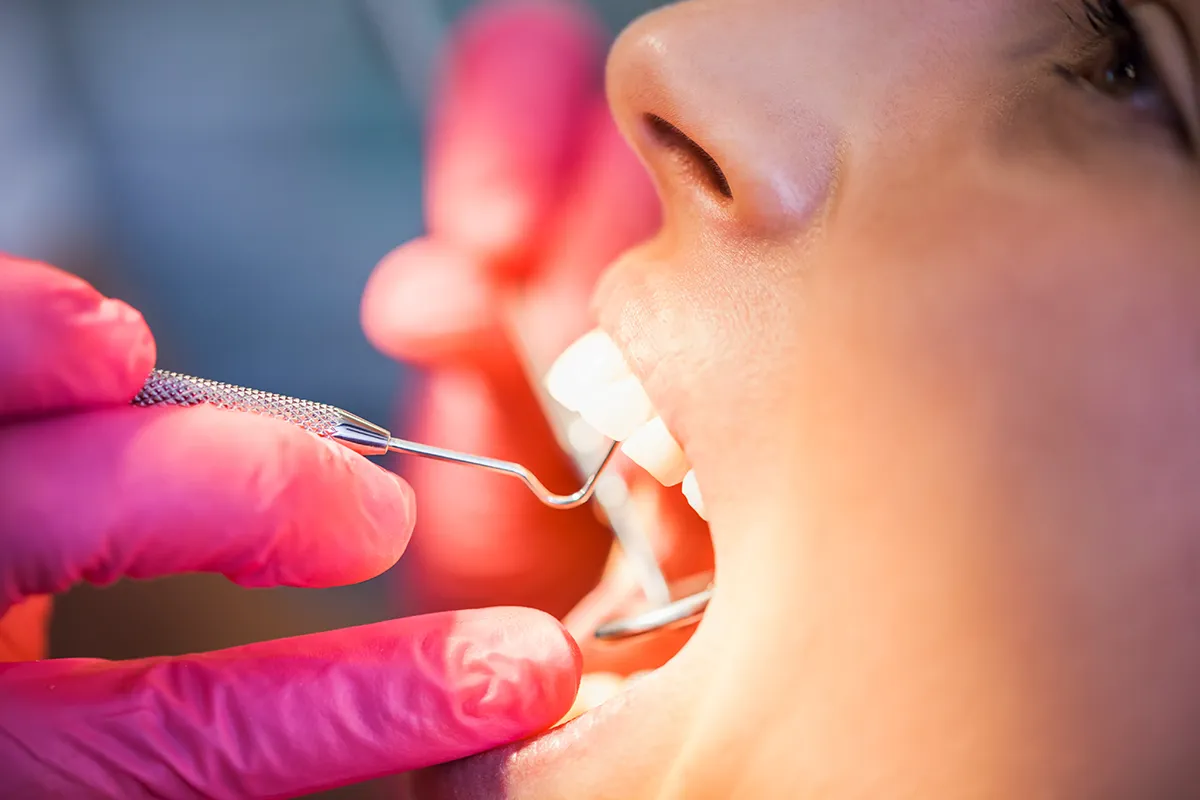 A close-up of a dental procedure showing a dentist wearing pink gloves using a dental explorer tool to examine a patient's front teeth. Retry