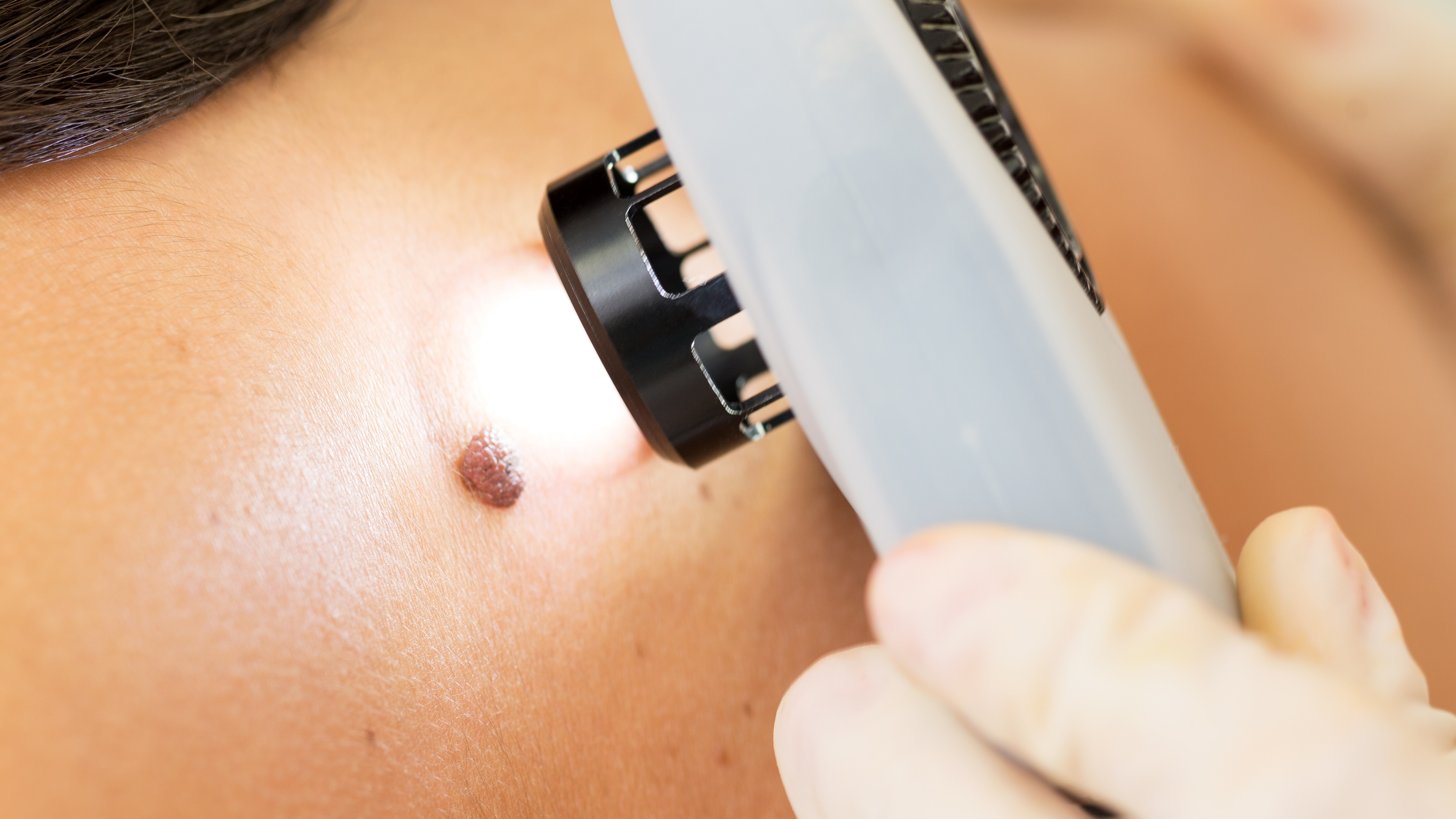 Melanoma skin cancer