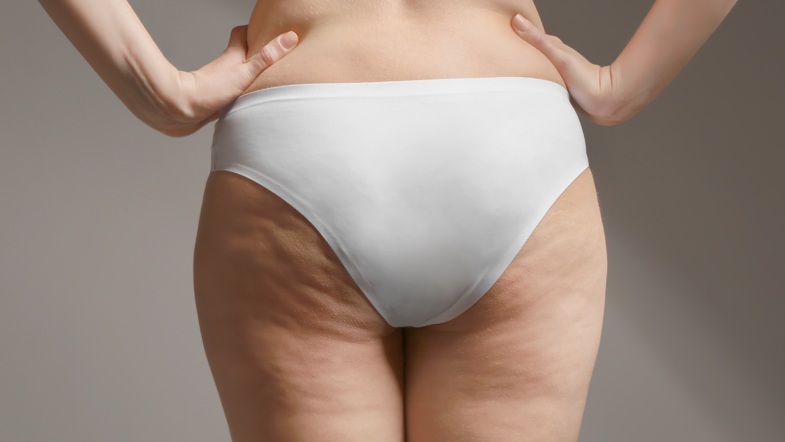 Cellulite an Oberschenkeln – Zeichen für schwaches Bindegewebe durch Kollagenverlust