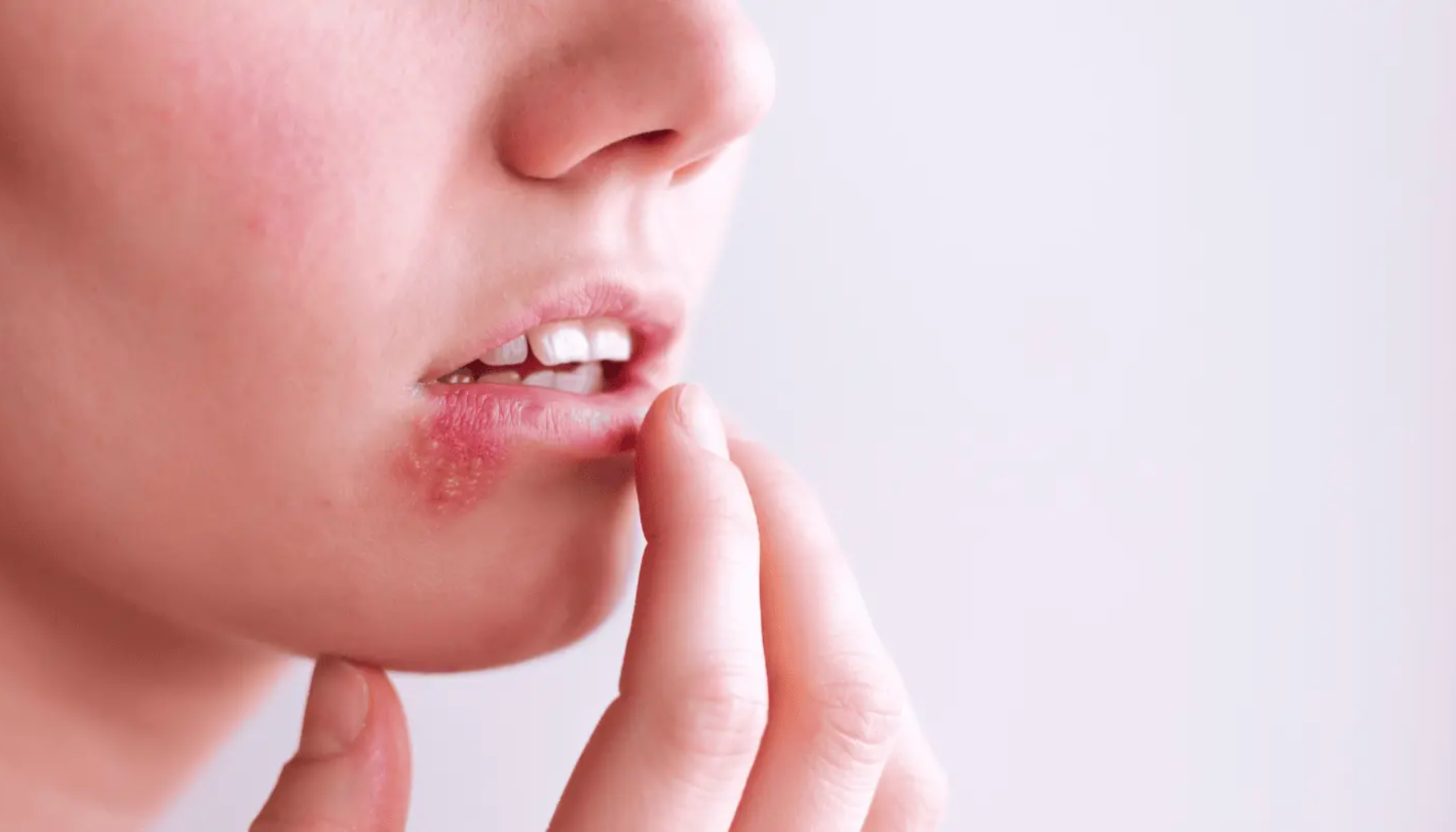 Person berører leppen forsiktig med fingeren, viser tydelig rødhet og blemme forårsaket av forkjølelsessår.