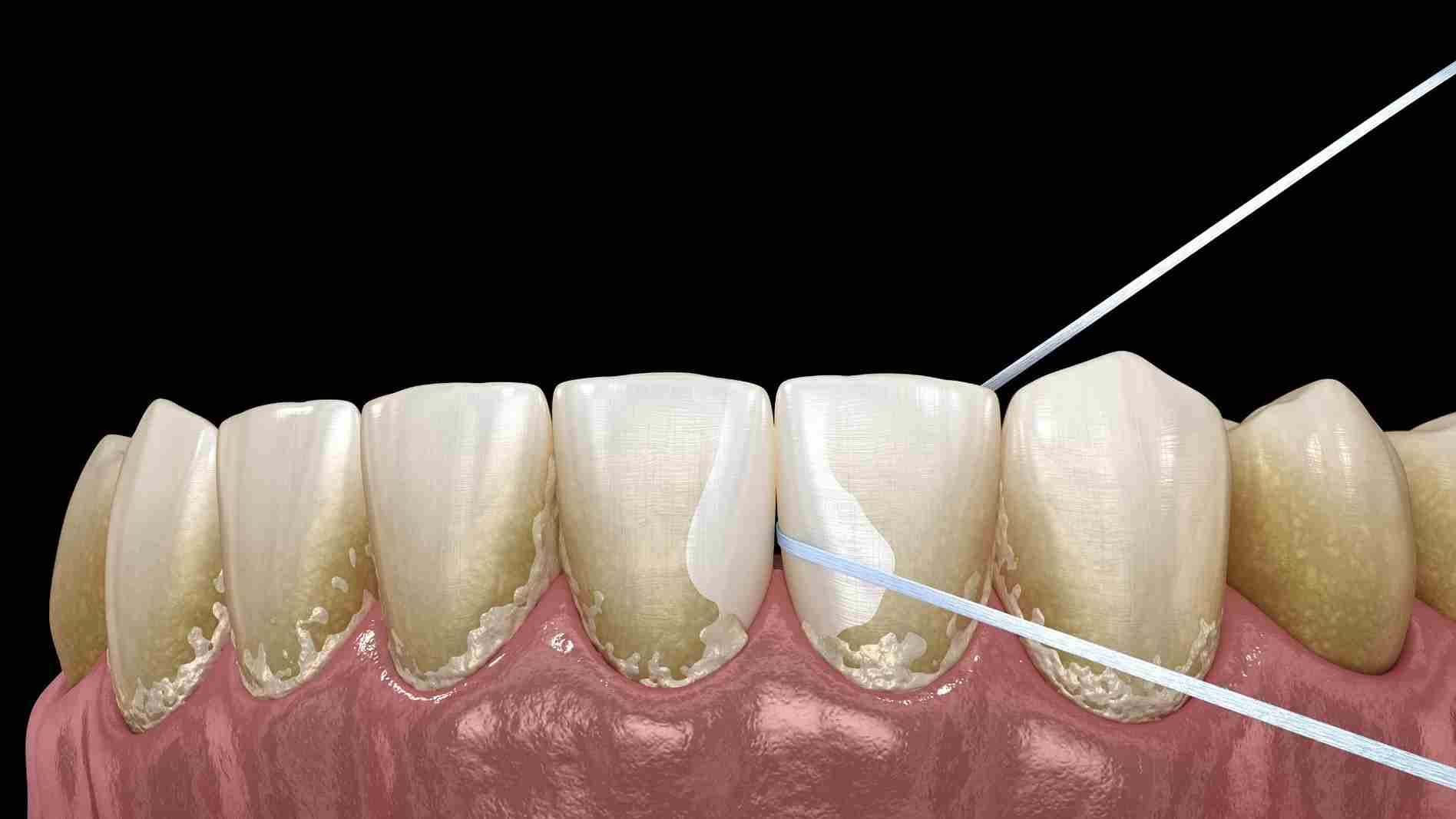 Tooth Model