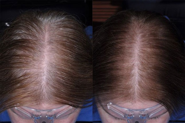 tratamiento-de-alopecia-en-madrid