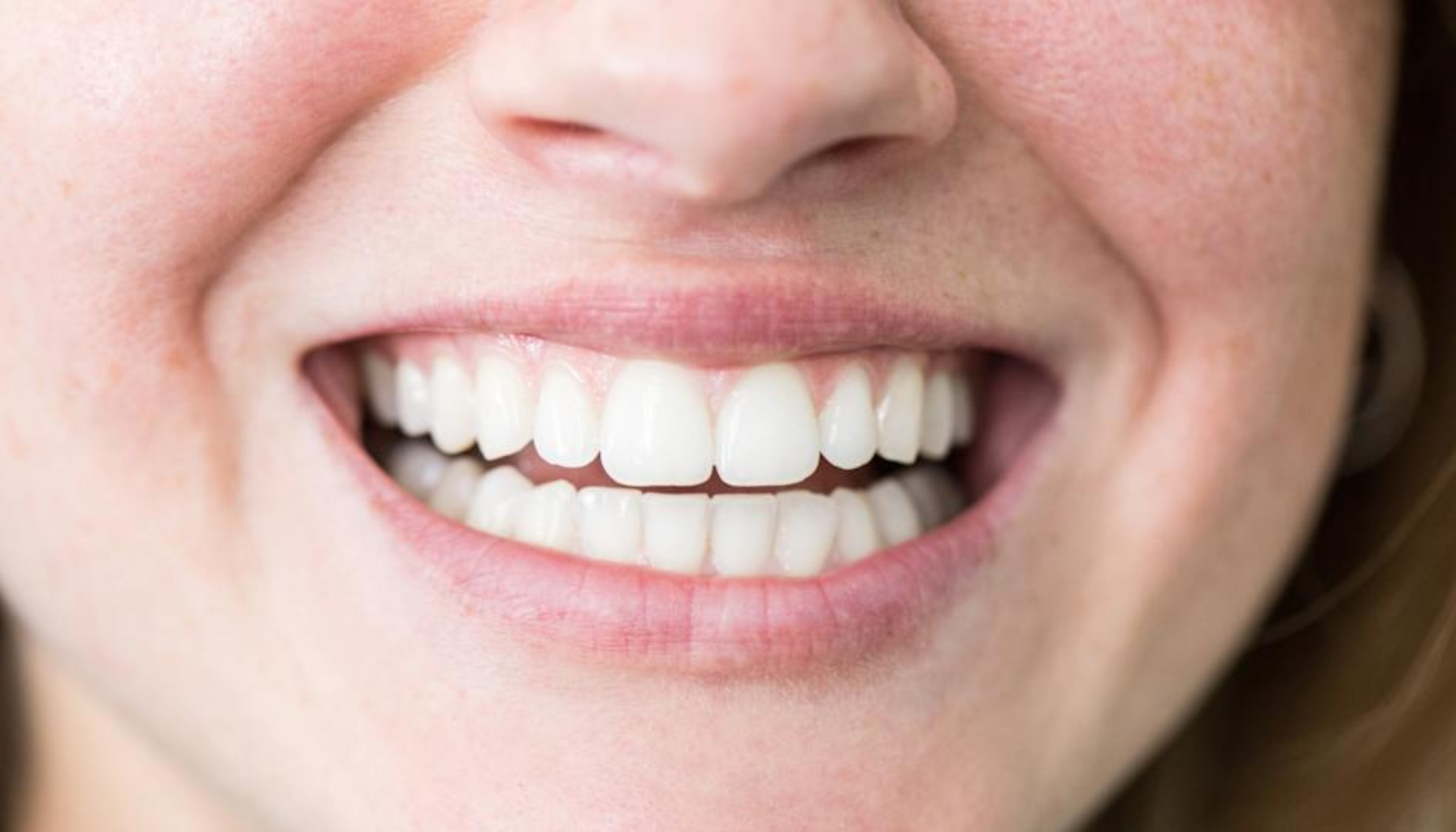 Nærbilde av en person som smiler og viser perfekte, hvite tenner og sunt tannkjøtt, med tydelige smilerynker rundt munnen.