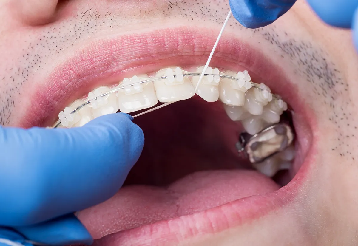 Closeup of dental professional using floss on clear orthodontic braces, demonstrating proper oral hygiene technique for patients with clear aligners.