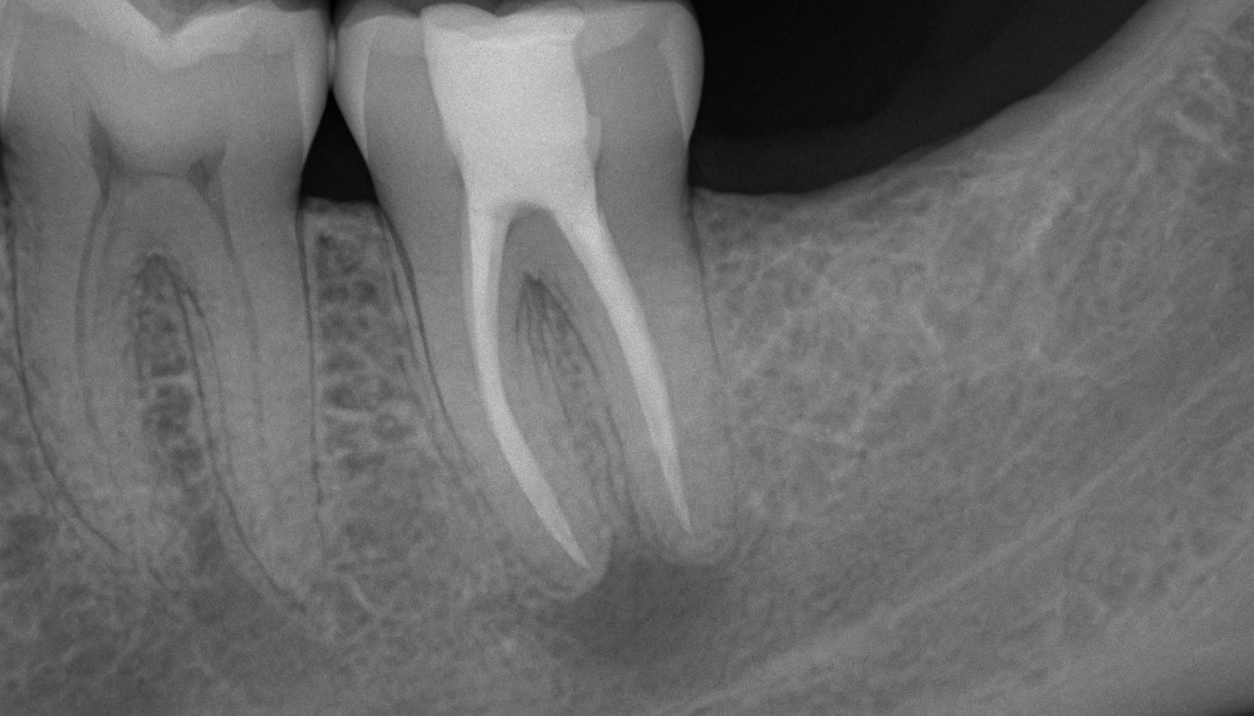 Røntgenbilde som viser tannrotbetennelse under en rotfylt tann med tydelig mørkt område ved rotspissen.