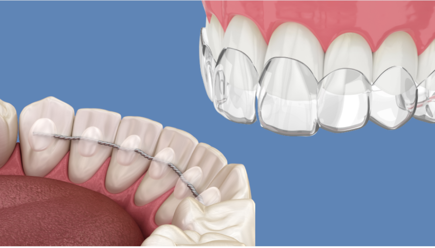 Illustrasjon av retainertråd på underkjeven og gjennomsiktig skinne på overkjeven brukt etter tannregulering.