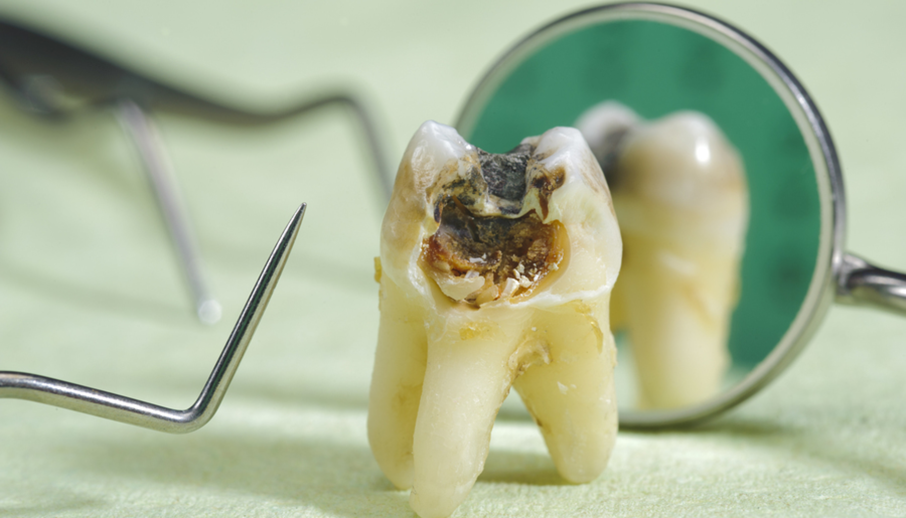 Råtten tann: Tegn, årsaker og når det haster med behandling 10 Råttent tann med stort hull undersøkt med speil og tannlegeinstrument på lys bakgrunn.
