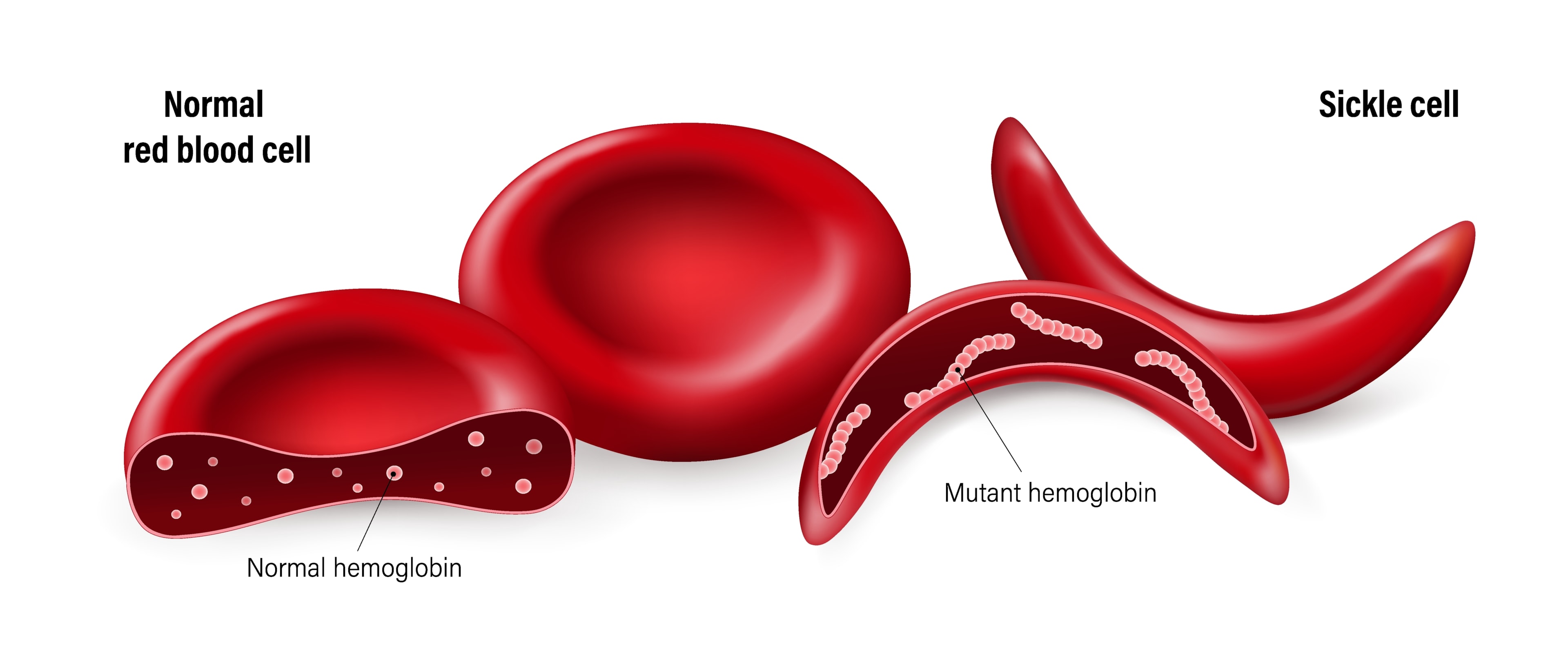 What is sickle cell anemia?