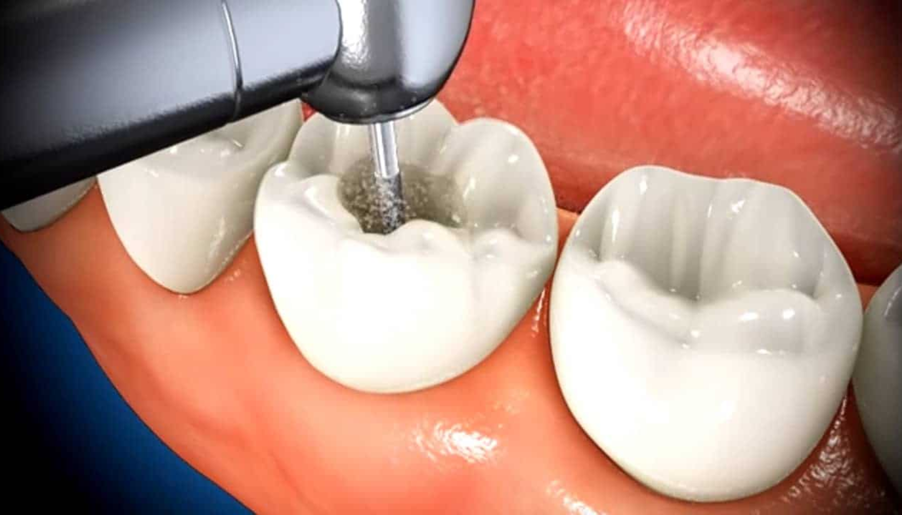 Borre hull: Slik foregår behandlingen Borre hull: Slik foregår behandlingen