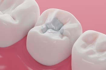 called pregnancy gingivitis