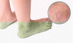 Varicose Veins in the Feet- What is the ...